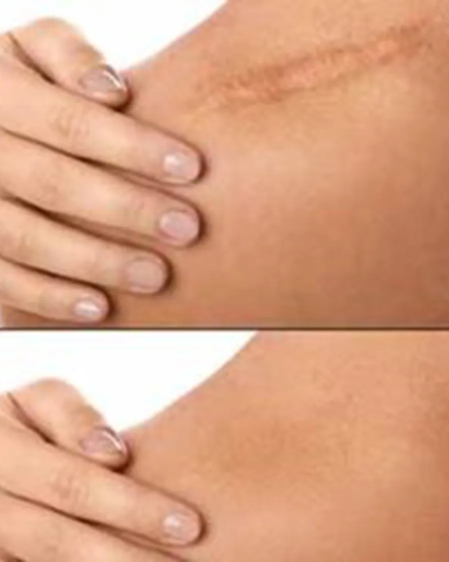 Scar Revision at Cinch Clinics